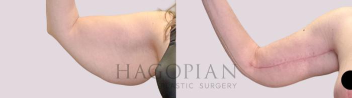 Before & After Arm Lift Case 241 Front Left View in Atlanta, GA