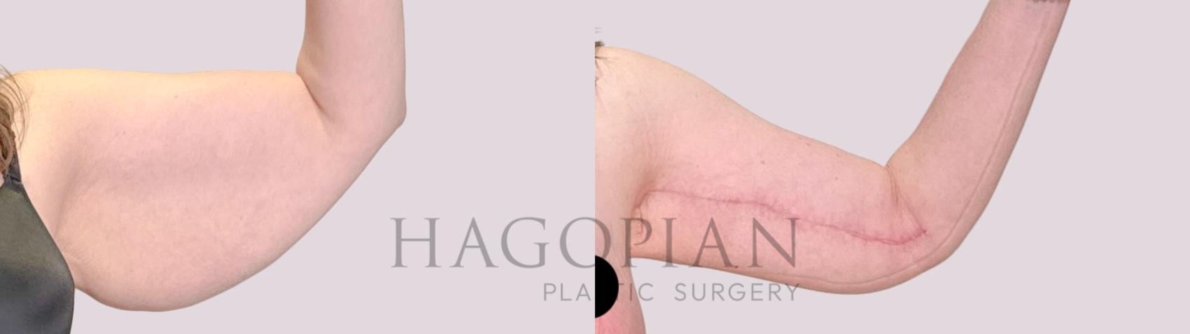 Before & After Arm Lift Case 241 Front Right View in Atlanta, GA