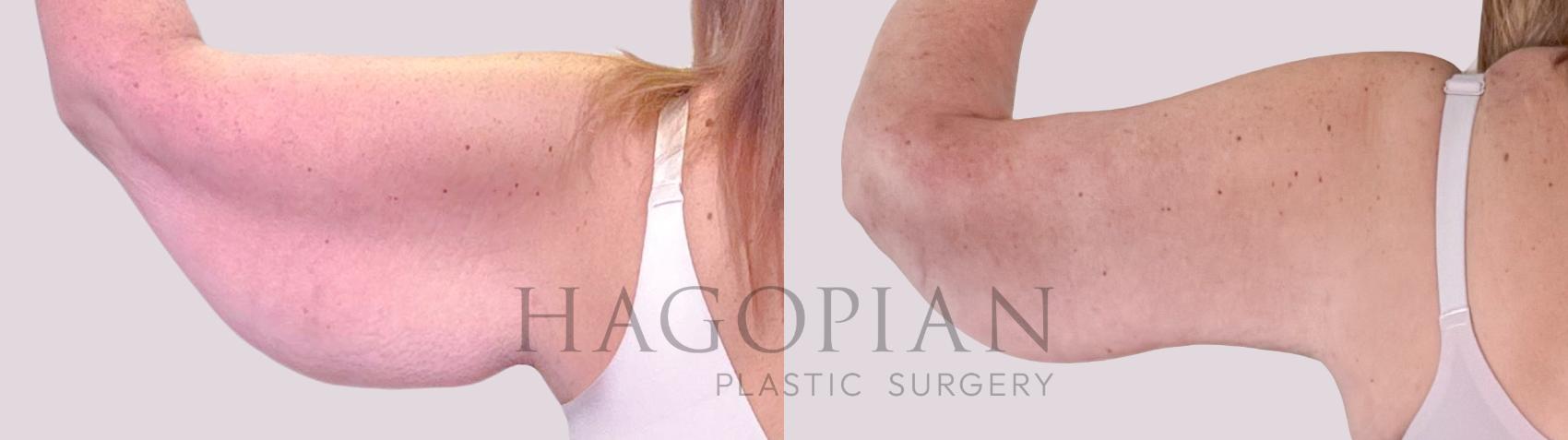 Before & After Arm Lift Case 244 Back Left View in Atlanta, GA