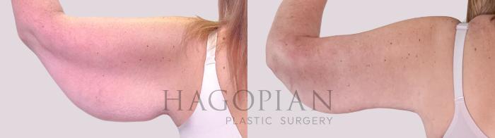 Before & After Arm Lift Case 244 Back Left View in Atlanta, GA