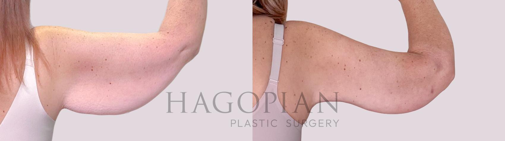 Before & After Arm Lift Case 244 Back Right View in Atlanta, GA