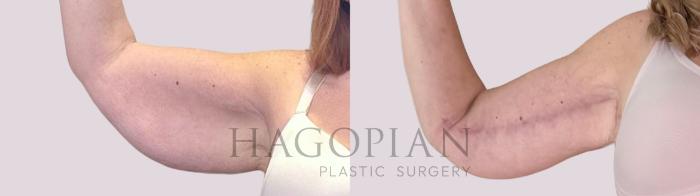 Before & After Arm Lift Case 244 Front Left View in Atlanta, GA