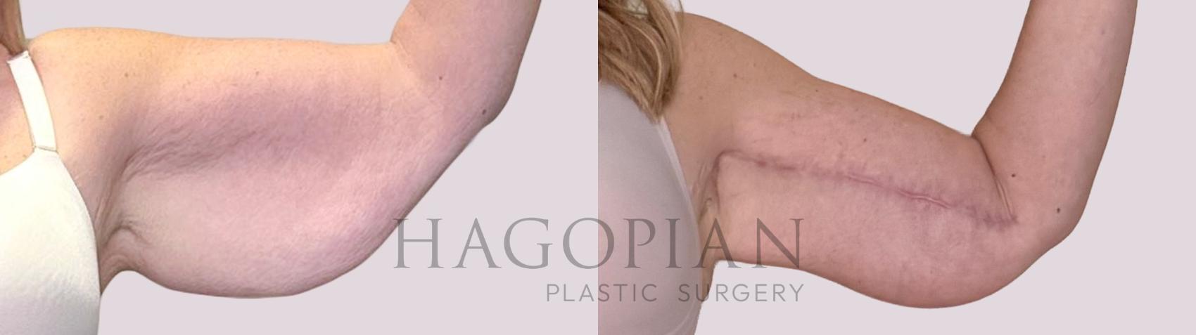 Before & After Arm Lift Case 244 Front Right View in Atlanta, GA