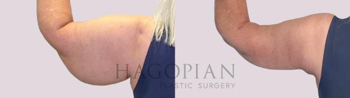 Before & After Arm Lift Case 249 Back Left View in Atlanta, GA