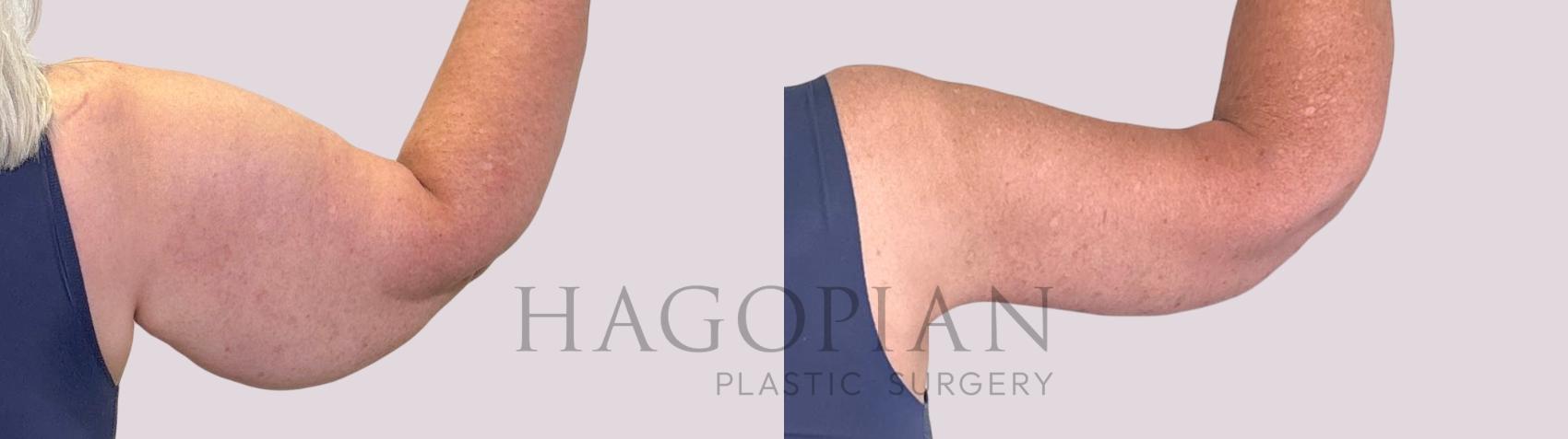 Before & After Arm Lift Case 249 Back Right View in Atlanta, GA