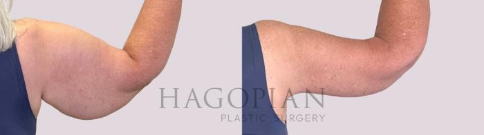 Before & After Arm Lift Case 249 Back Right View in Atlanta, GA