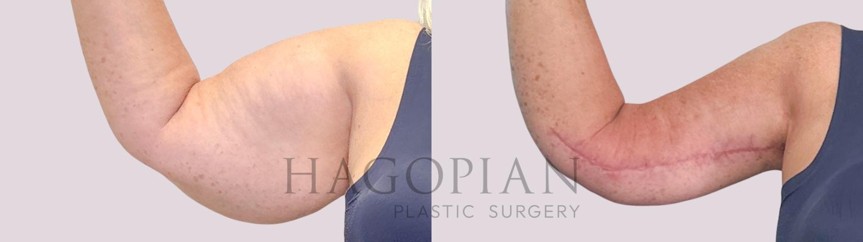 Before & After Arm Lift Case 249 Front Left View in Atlanta, GA
