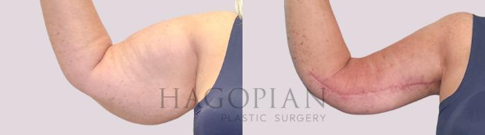 Before & After Arm Lift Case 249 Front Left View in Atlanta, GA