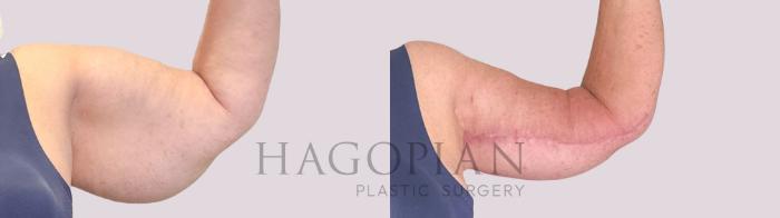 Before & After Arm Lift Case 249 Front Right View in Atlanta, GA