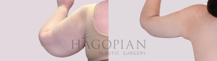 Before & After Arm Lift Case 250 Back Left View in Atlanta, GA