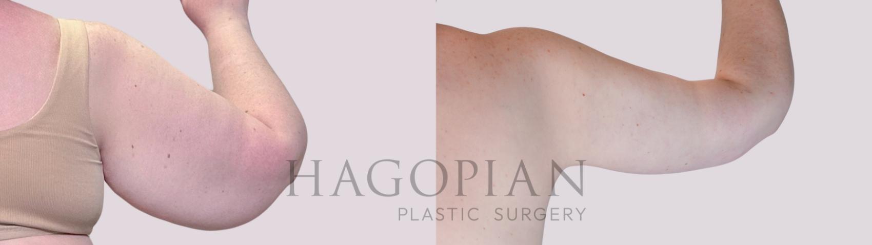 Before & After Arm Lift Case 250 Back Right View in Atlanta, GA