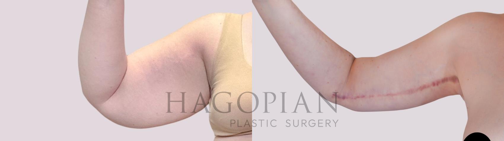 Before & After Arm Lift Case 250 Front Left View in Atlanta, GA