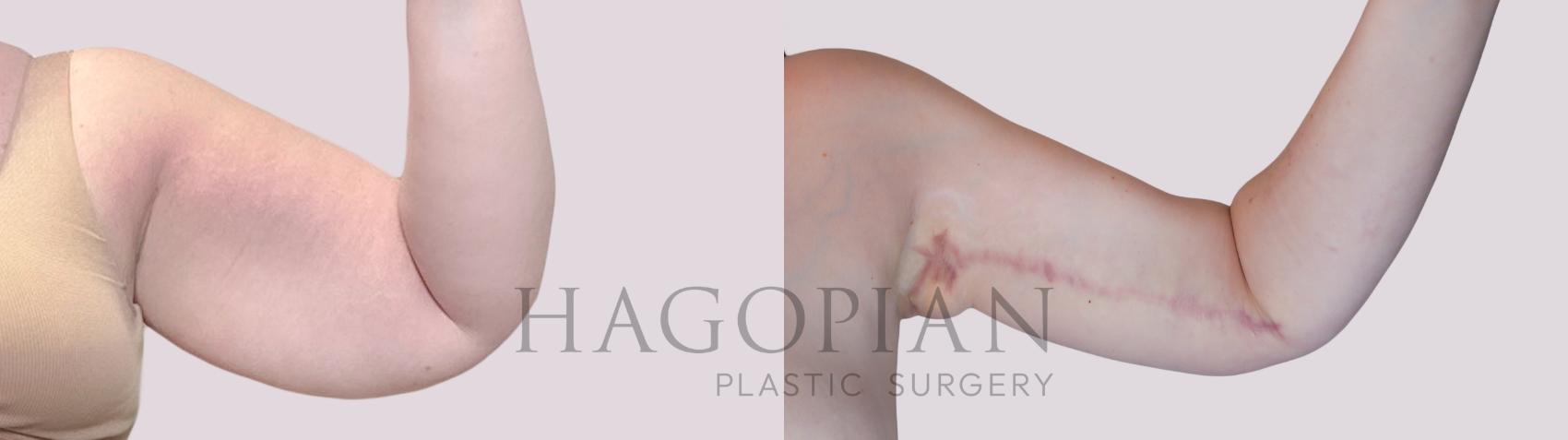 Before & After Arm Lift Case 250 Front Right View in Atlanta, GA