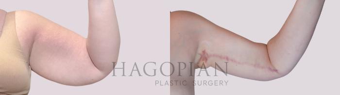 Before & After Arm Lift Case 250 Front Right View in Atlanta, GA