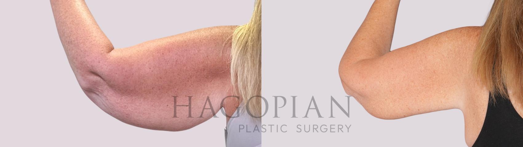 Before & After Arm Lift Case 252 Back Left View in Atlanta, GA