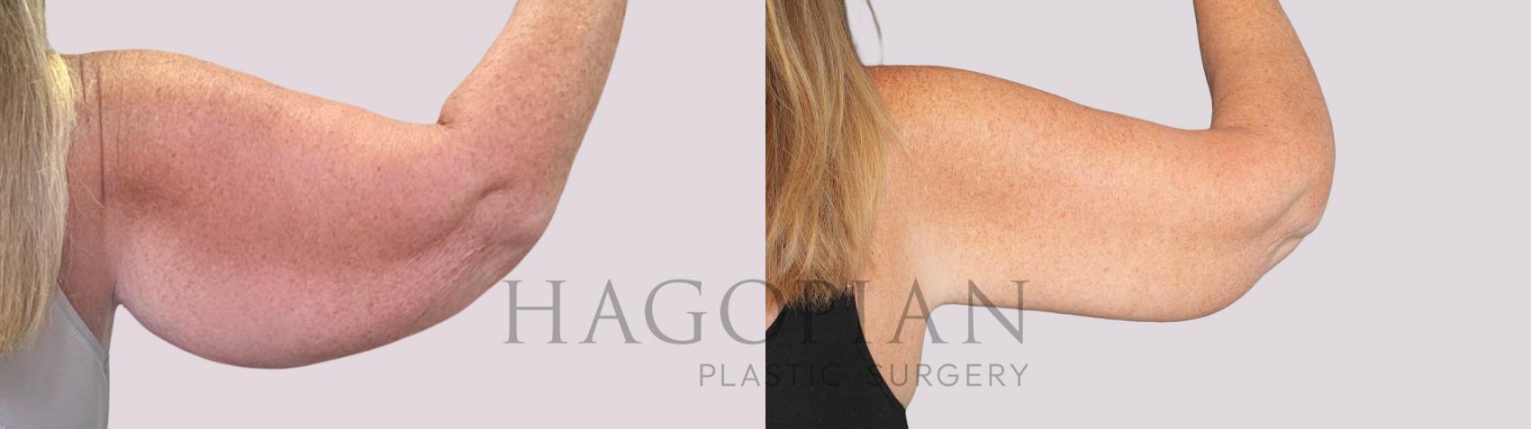 Before & After Arm Lift Case 252 Back Right View in Atlanta, GA