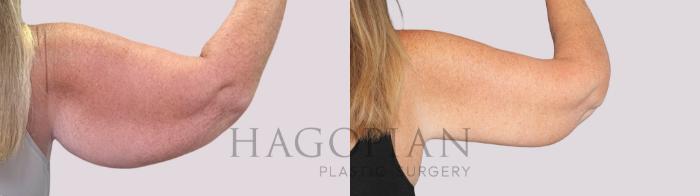 Before & After Arm Lift Case 252 Back Right View in Atlanta, GA