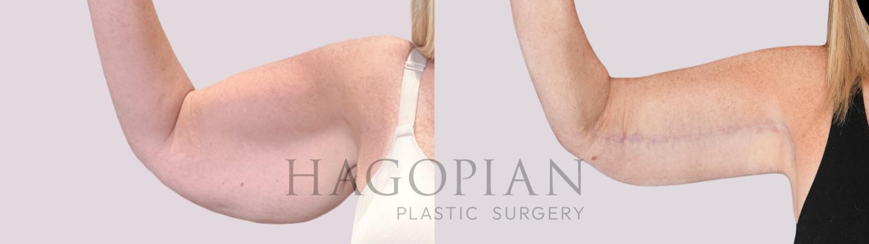 Before & After Arm Lift Case 252 Front Left View in Atlanta, GA