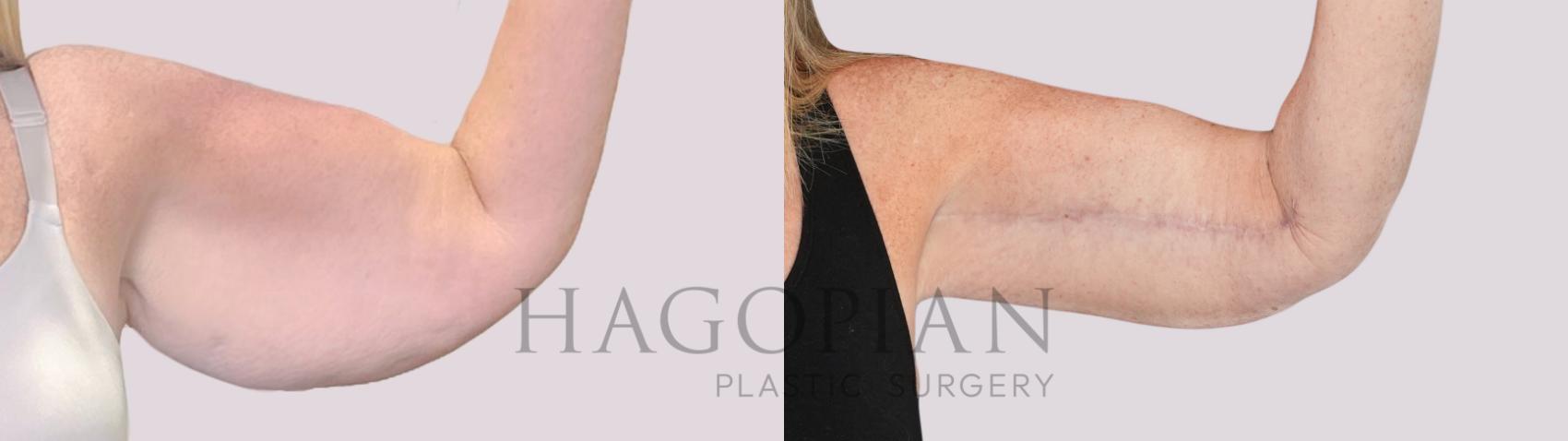 Before & After Arm Lift Case 252 Front Right View in Atlanta, GA