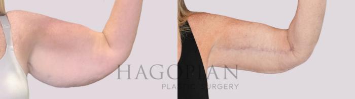 Before & After Arm Lift Case 252 Front Right View in Atlanta, GA