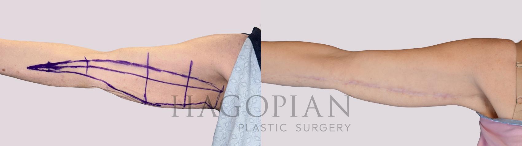 Before & After Arm Lift Case 254 Front Left View in Atlanta, GA