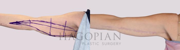 Before & After Arm Lift Case 254 Front Left View in Atlanta, GA