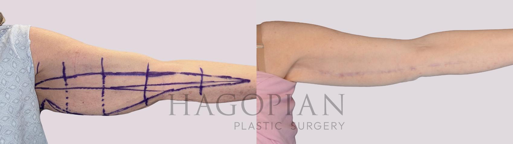 Before & After Arm Lift Case 254 Front Right View in Atlanta, GA