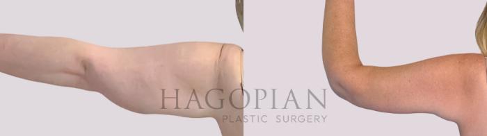 Before & After Arm Lift Case 257 Back Left View in Atlanta, GA