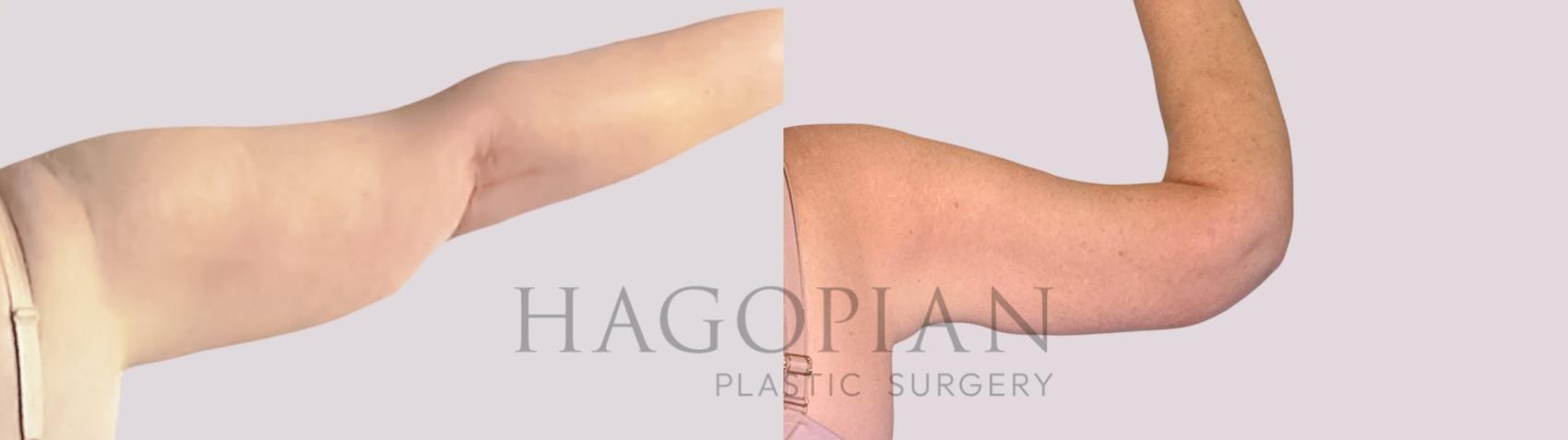 Before & After Arm Lift Case 257 Back Right View in Atlanta, GA