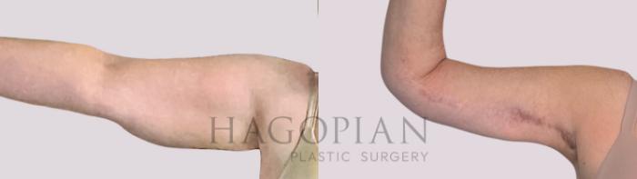 Before & After Arm Lift Case 257 Front Left View in Atlanta, GA