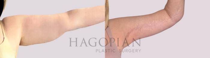 Before & After Arm Lift Case 257 Front Right View in Atlanta, GA