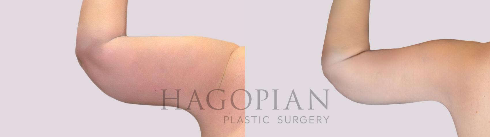 Before & After Arm Lift Case 258 Back Left View in Atlanta, GA