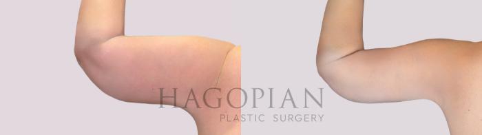 Before & After Arm Lift Case 258 Back Left View in Atlanta, GA