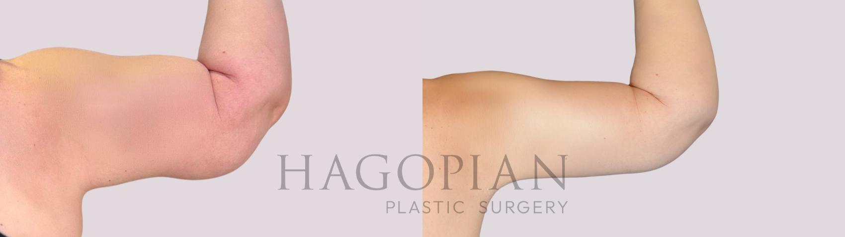 Before & After Arm Lift Case 258 Back Right View in Atlanta, GA