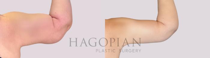 Before & After Arm Lift Case 258 Back Right View in Atlanta, GA