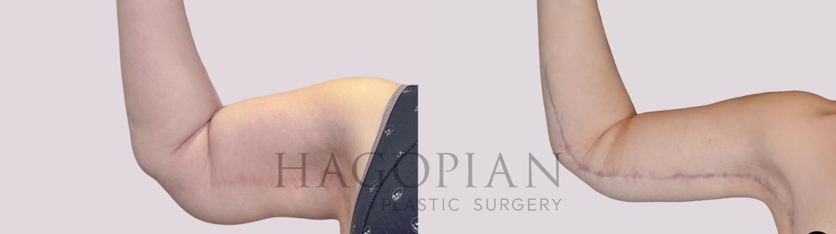 Before & After Arm Lift Case 258 Front Left View in Atlanta, GA