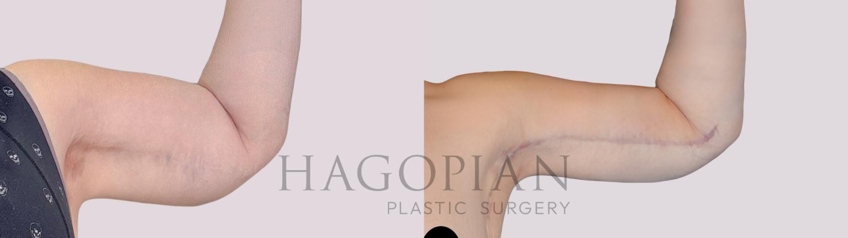 Before & After Arm Lift Case 258 Front Right View in Atlanta, GA