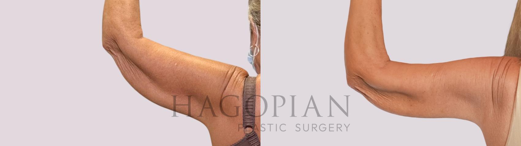 Before & After Arm Lift Case 260 Back Left View in Atlanta, GA