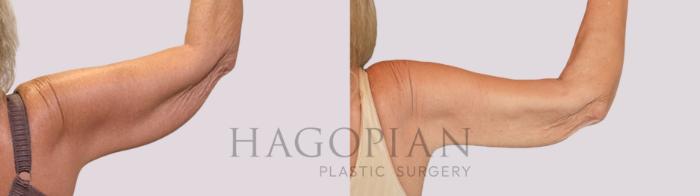 Before & After Arm Lift Case 260 Back Right View in Atlanta, GA