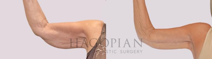 Before & After Arm Lift Case 260 Front Left View in Atlanta, GA