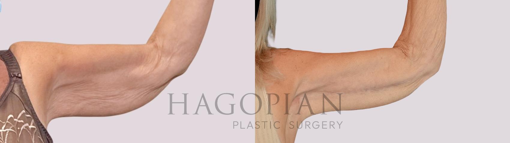 Before & After Arm Lift Case 260 Front Right View in Atlanta, GA