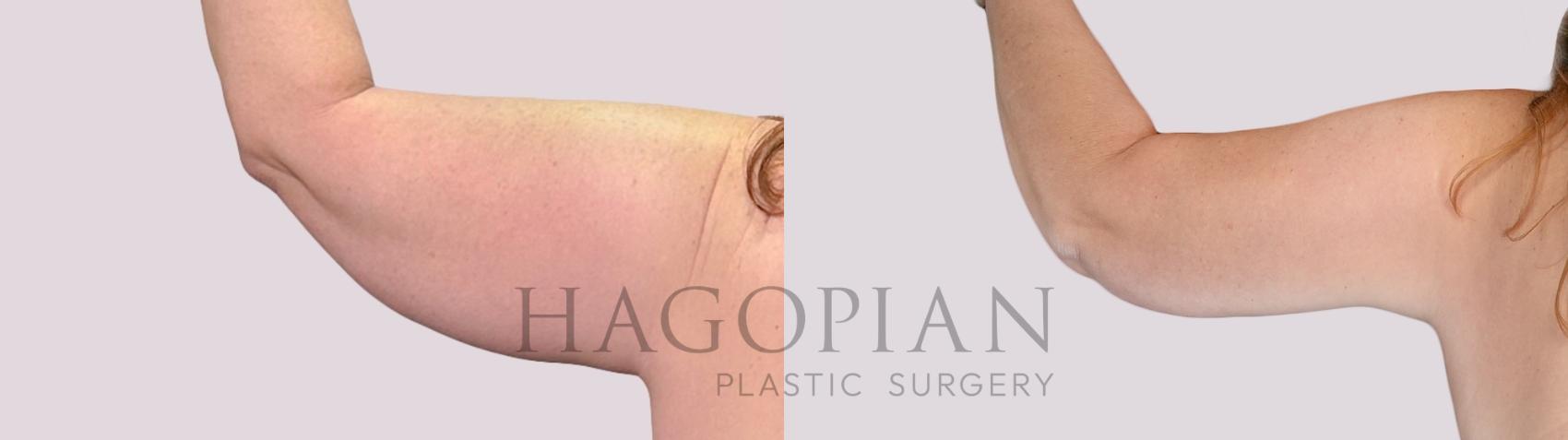 Before & After Arm Lift Case 262 Back Left View in Atlanta, GA