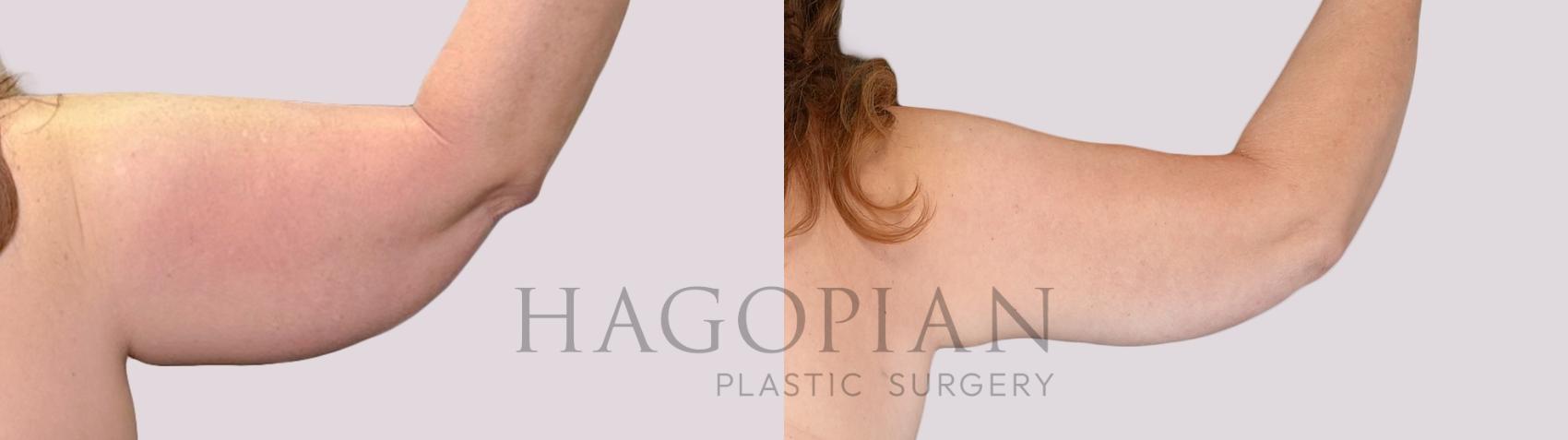 Before & After Arm Lift Case 262 Back Right View in Atlanta, GA