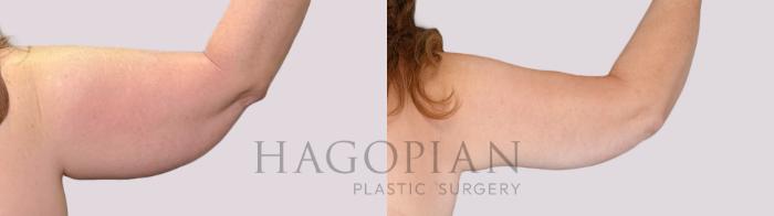 Before & After Arm Lift Case 262 Back Right View in Atlanta, GA