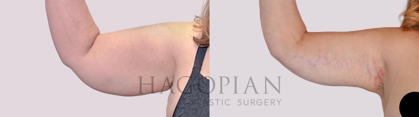 Before & After Arm Lift Case 262 Front Left View in Atlanta, GA