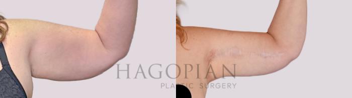 Before & After Arm Lift Case 262 Front Right View in Atlanta, GA