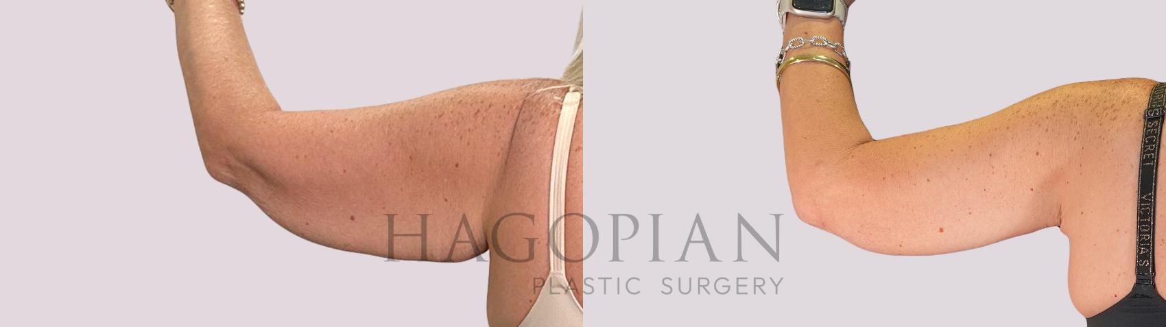 Before & After Arm Lift Case 267 Back Left View in Atlanta, GA