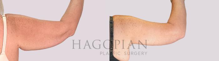Before & After Arm Lift Case 267 Back Right View in Atlanta, GA