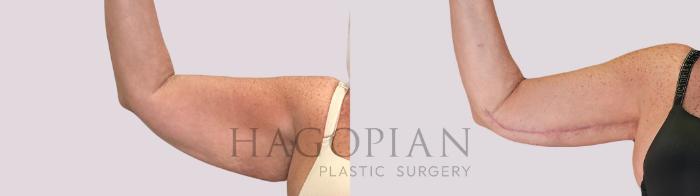 Before & After Arm Lift Case 267 Front Left View in Atlanta, GA