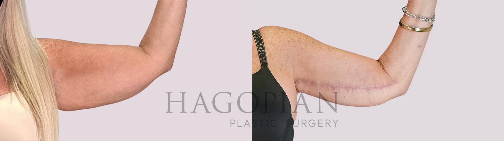 Before & After Arm Lift Case 267 Front Right View in Atlanta, GA